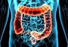 Rectal Cancer Now One-Third of All Colorectal Diagnoses in US Study
